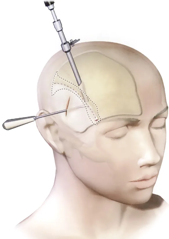 Lifting Endoscópico