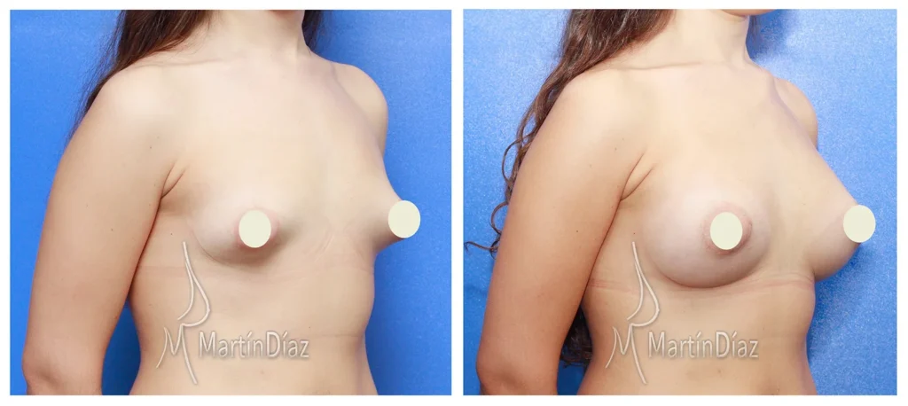 imagenes mamosplastia antes despues - Dr. Martin Diaz - Cirugía Estética