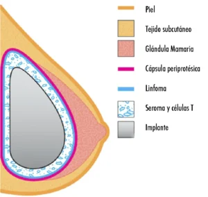 linfoma mamario - Dr. Martin Diaz - Cirugía Estética