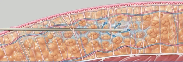 procedimiento liposuccion vaser foto 1 - Dr. Martin Diaz - Cirugía Estética