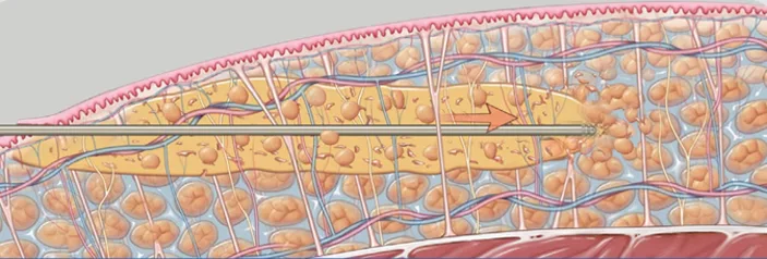 procedimiento liposuccion vaser foto 2 - Dr. Martin Diaz - Cirugía Estética