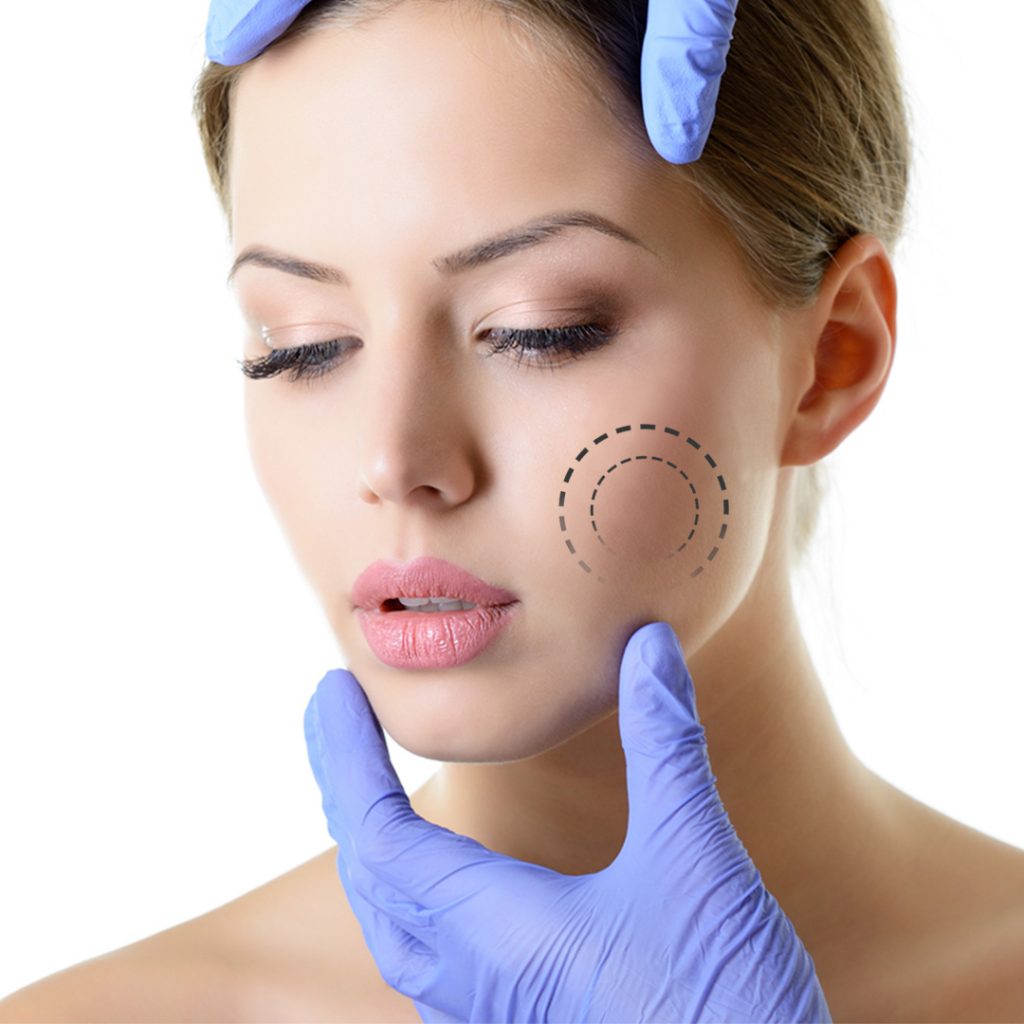 Qué es una bichectomía