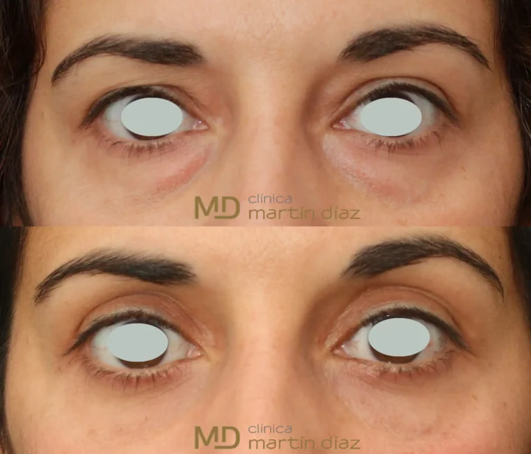 blefaroplastia