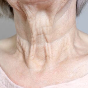 como quitar las arrugas del cuello