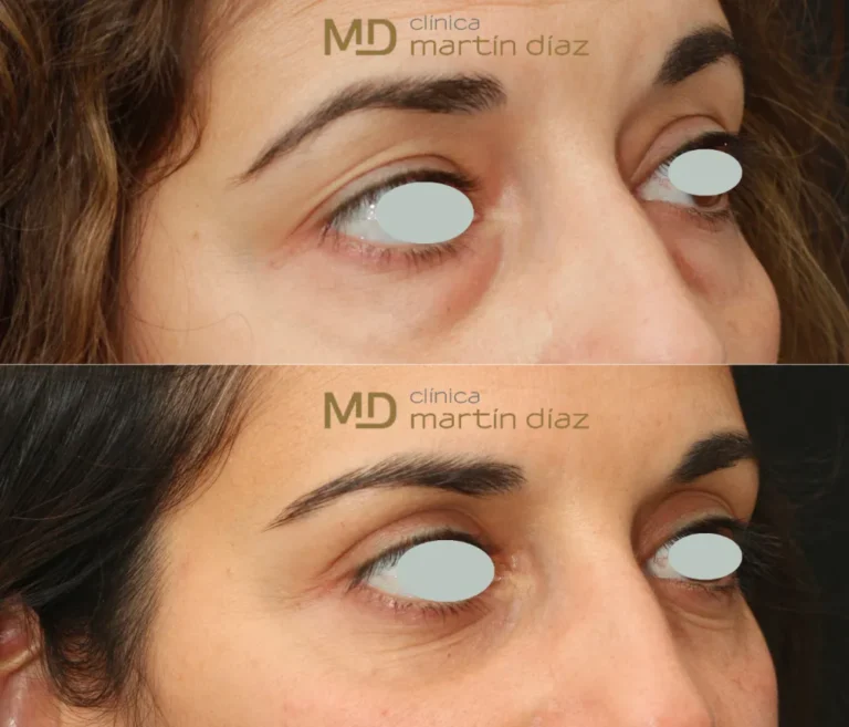 Blefaroplastia 3