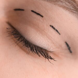 Blefaroplastia mal hecha